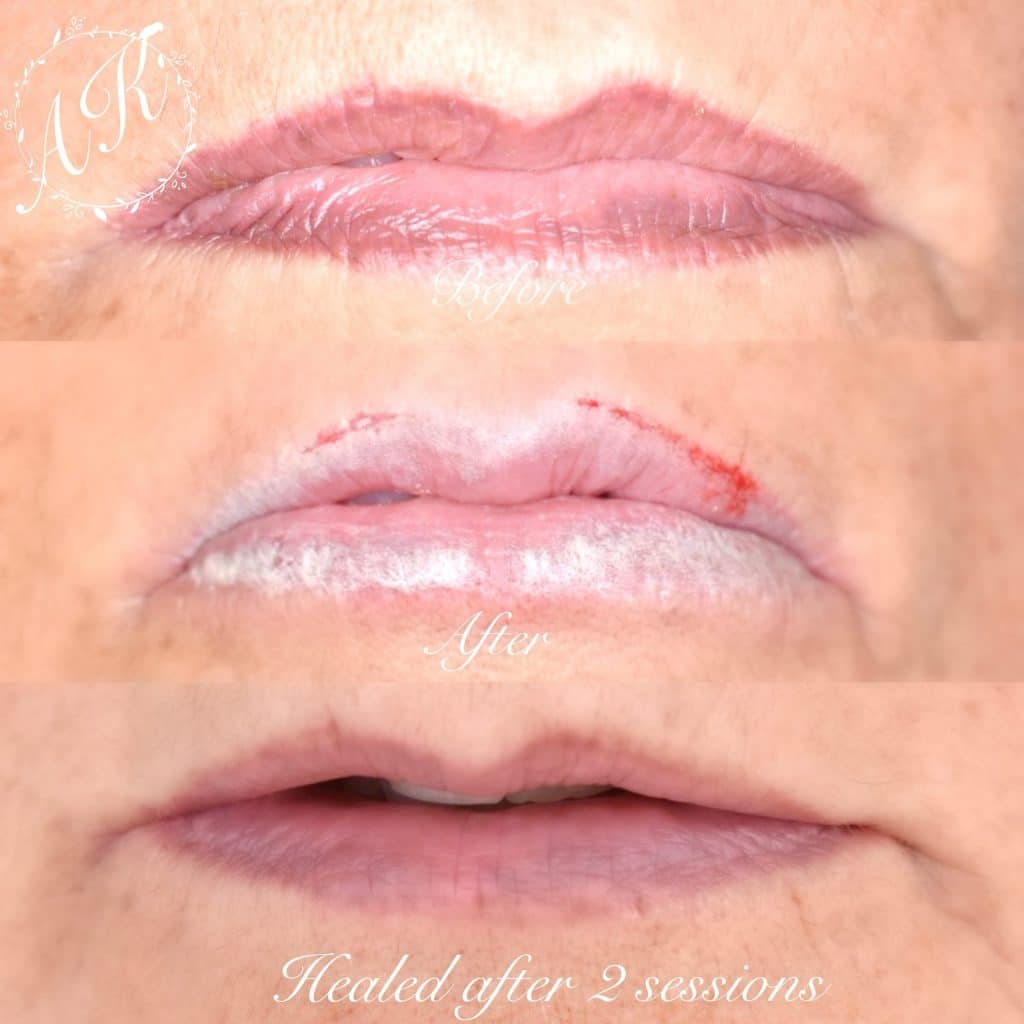 Salt Saline Removal London - Before and after