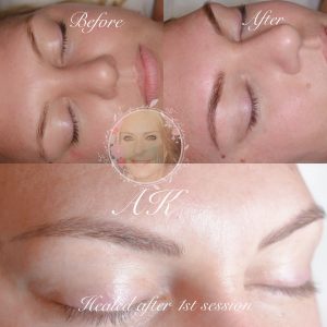 Healed microblading