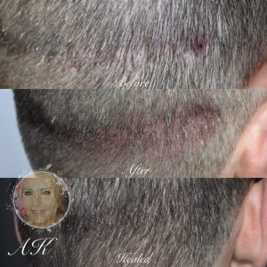 scalp tattoo