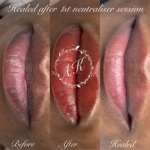 Discoloured lip correction