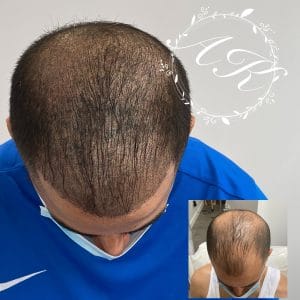 scalp pigmentation