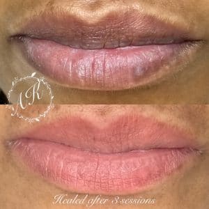 Dark lip correction