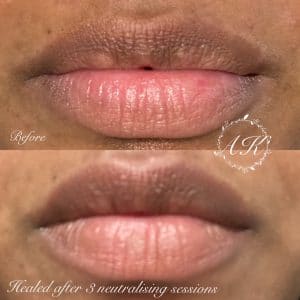 Dark lip correction