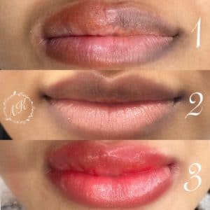 Dark lip neutralising treatment