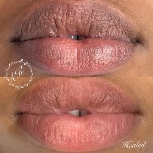 Dark lip correction