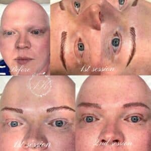 Microblading alopecia