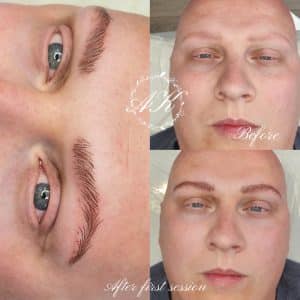 Microblading alopecia