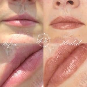 Lip correction and scar camouflage