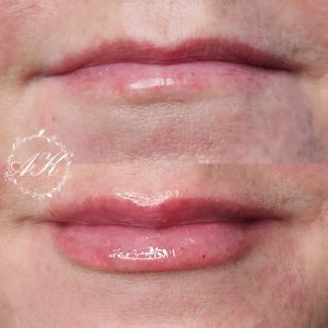 Dermal filler in lips and marionette lines