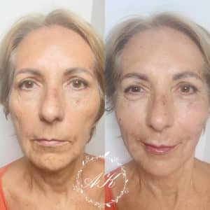 Profile balance with dermal fillers