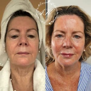 Mesotherapy face, neck and decolletage immediately after