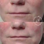 Dermal filler in marionette lines and nasolabial folds