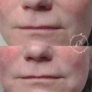 Dermal filler in marionette lines and nasolabial folds
