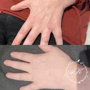 Hand booster, healed after 1 session