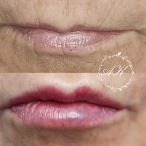 Dermal filler lips
