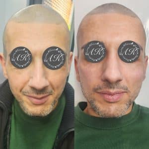 Cheek and mid face filler