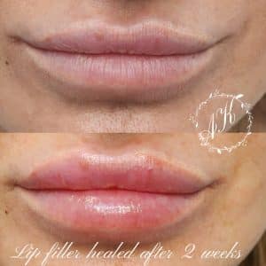 Dermal lip filler