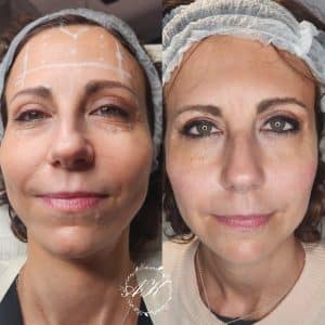 2 x Eye boosters, cheek filler and anti wrinkle treatments.