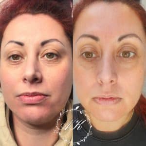 Skin and eye booster, healed after 2 sessions