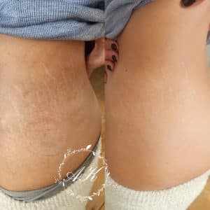 Microneedling with exosomes after 2 sessions