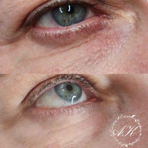 Polynucleotide injection under the eyes, healed after 1 session