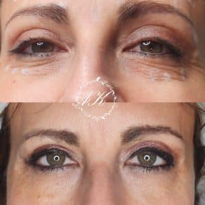 Polynucleotide injection under the eyes, healed after 2 sessions
