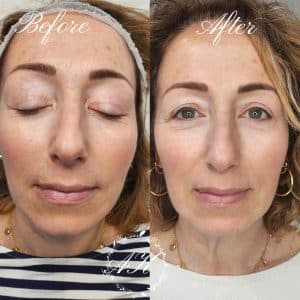 Skin booster, healed after 1st session