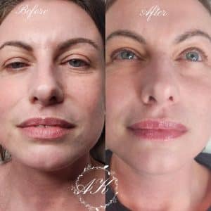 Skin booster, healed after 1st session