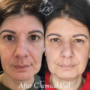 Chemical peel