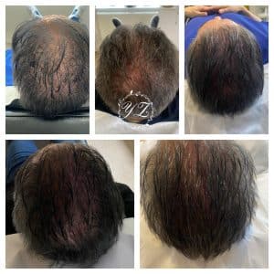 PRP for hair loss