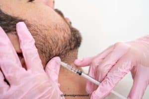 PRP for beard