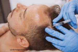 PRP for hair loss