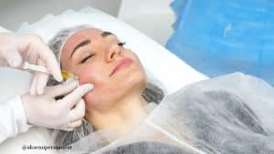 Vampire face lift