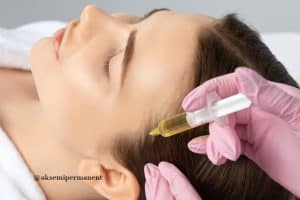 PRP for hair loss