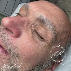 Healed microblading