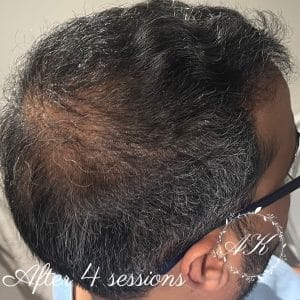 PRP therapy for hair loss