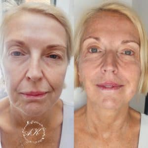 Dermal filler cheeks and nasolabial folds.