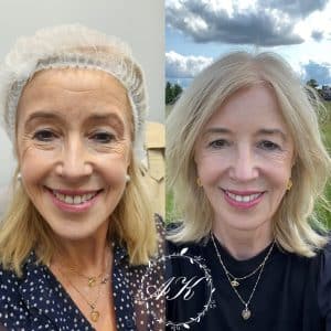 Anti wrinkle treatment.
