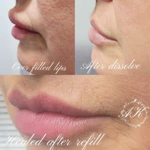 Correction of Lip filler.