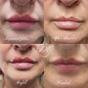 Lip filler correction and refill.
