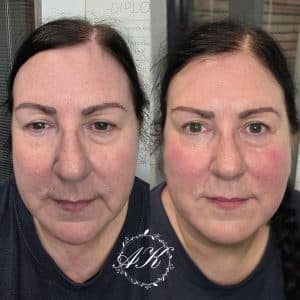 Dermal Filler in cheeks and marionette lines.