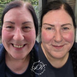 Anti wrinkle treatments