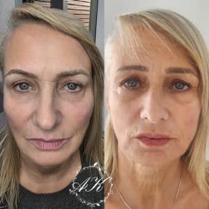 Dermal Filler in cheeks and anti wrinkle treatment.