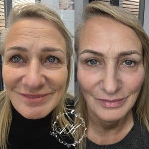 Dermal Filler and anti wrinkle treatment.
