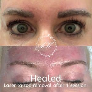 Eyebrow Laser Tattoo Removal