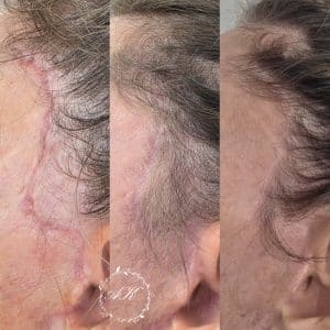 PRP for scar therapy