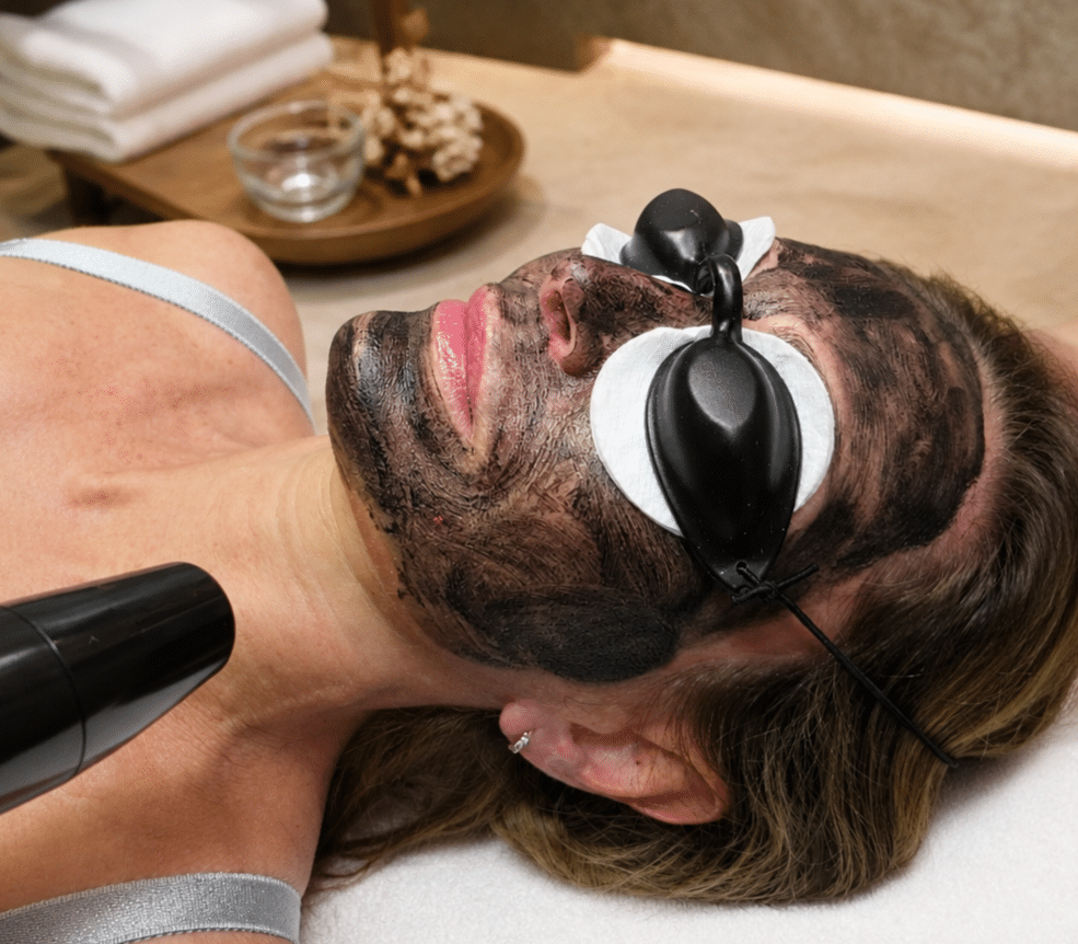 Carbon laser facial