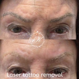 Laser Tattoo Removal