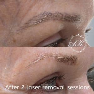 Microblading removal